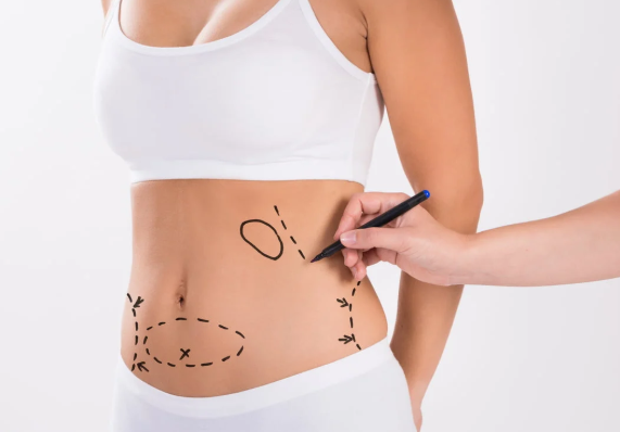 The Different Types of Liposuction Techniques Explained